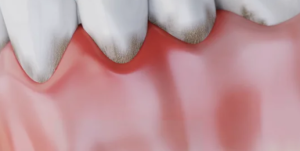 Parodontite et formation d'une poche parodontale